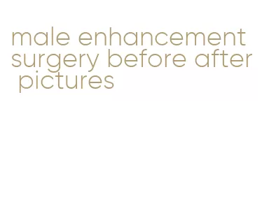 male enhancement surgery before after pictures